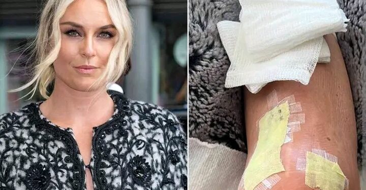 “The Only Failure in Life Is Not Trying”: Lindsey Vonn’s Powerful Message After Devastating Olympic Crash and Successful Surgery